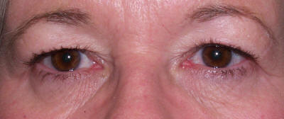 A close-up image of eyelids before and after blepharoplasty surgery, showing improved symmetry and reduction of ptosis.